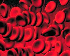 Ansammlung von Ketonkörpern im Blut bei Diabetes